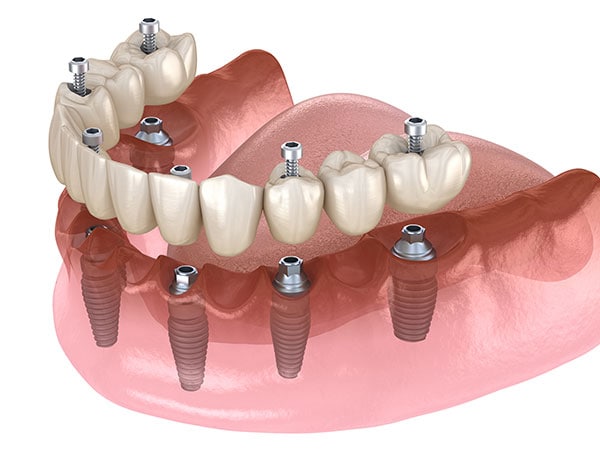 All On 6 Implant Services Elite Dental Lab   All On 6 